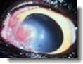 corneal ulcer